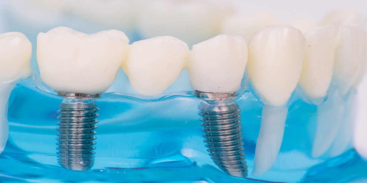 dental implants toronto by Dentistry at Vitality Health Compleo