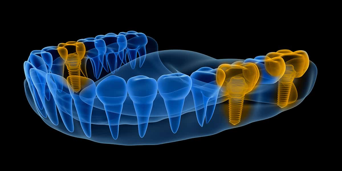 dental implants for jawbone density - Dentistry at Vitality Health Compleo