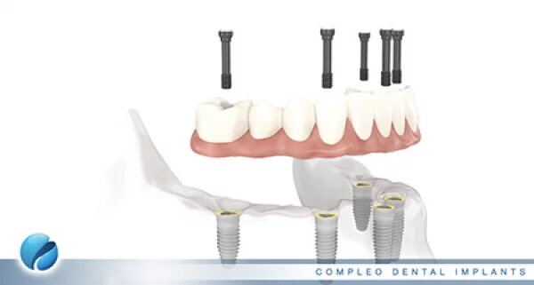 single multiple arch - dental implant toronto