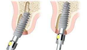 immediate dental implant tool - Dentistry at Vitality Health Compleo