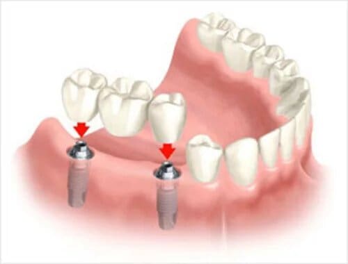 implant bridge by Dentistry at Vitality Health Compleo