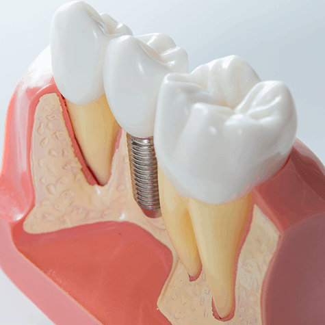 dental implant in toronto