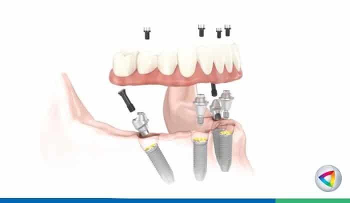 dental implant toronto - Dentistry at Vitality Health Compleo