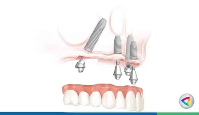 dental implant toronto - Dentistry at Vitality Health Compleo