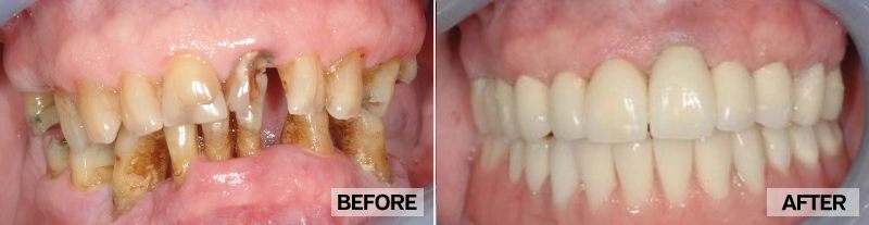 before and after dental implant in toronto