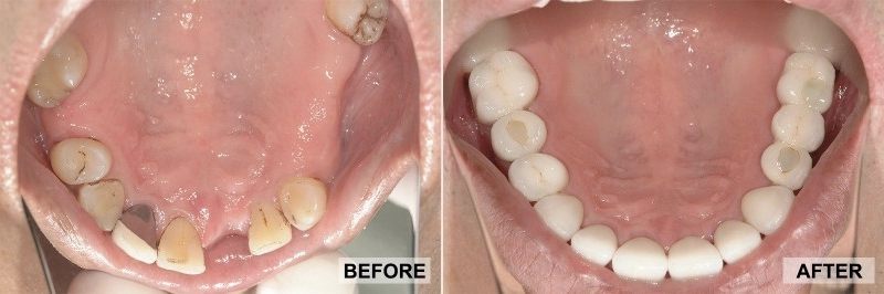 before and after dental implant in toronto
