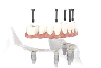 all on six dental implant toronto - Dentistry at Vitality Health Compleo