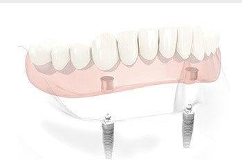 implant supported denture - Dentistry at Vitality Health Compleo