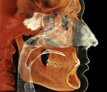 jawbone - Dentistry at Vitality Health Compleo