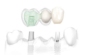 dental implants toronto by Dentistry at Vitality Health Compleo