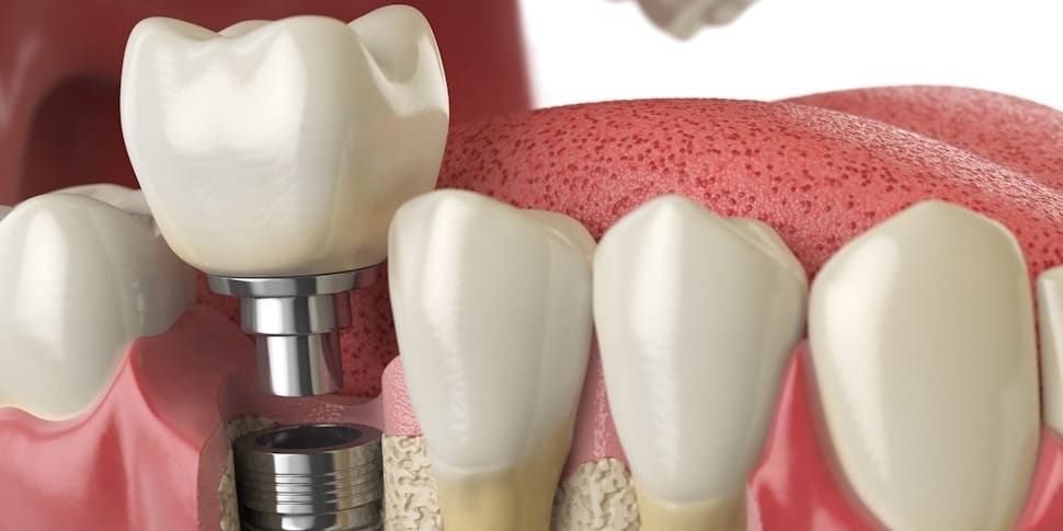 dental implant toronto by Dentistry at Vitality Health Compleo