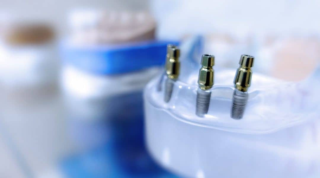 Long-Lasting Benefits Of Dental Implants To Your Oral Health