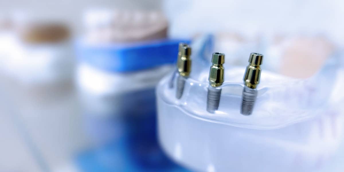 titanium dental implants - Markham Dentists at Compleo at Dentistry at Vitality Health